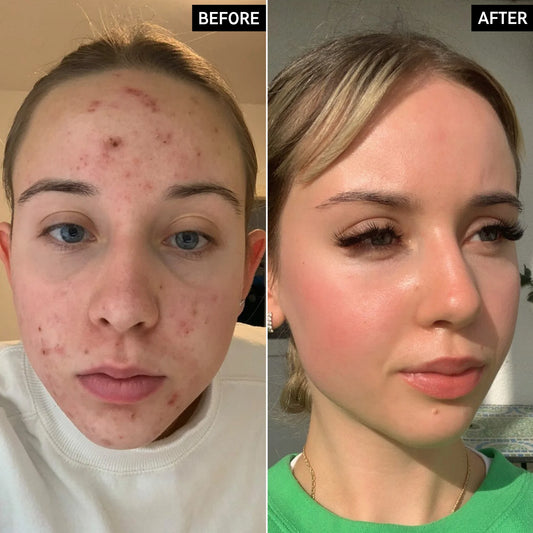 Concealer voor donkere vlekken